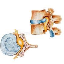 Sleep Disc(Disc Prolapsed)